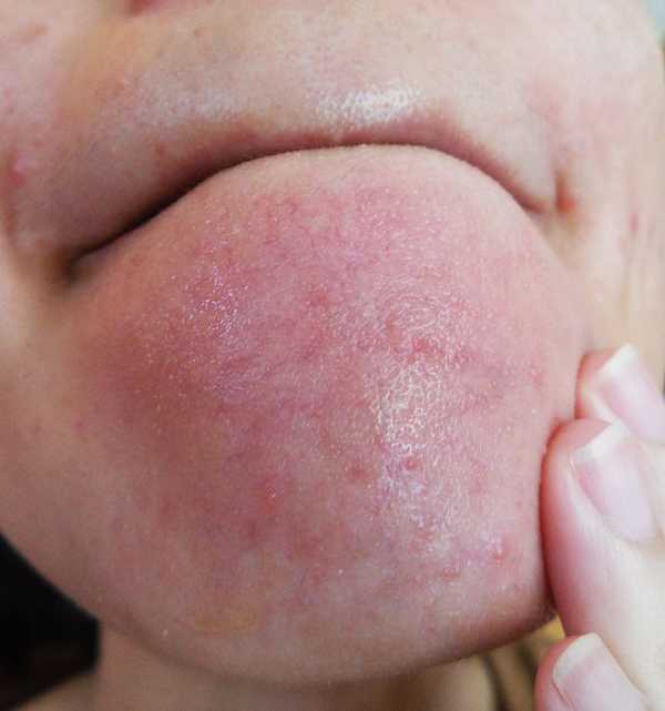 鑽美姬面皰粉刺油脂調理精華預防面皰粉刺