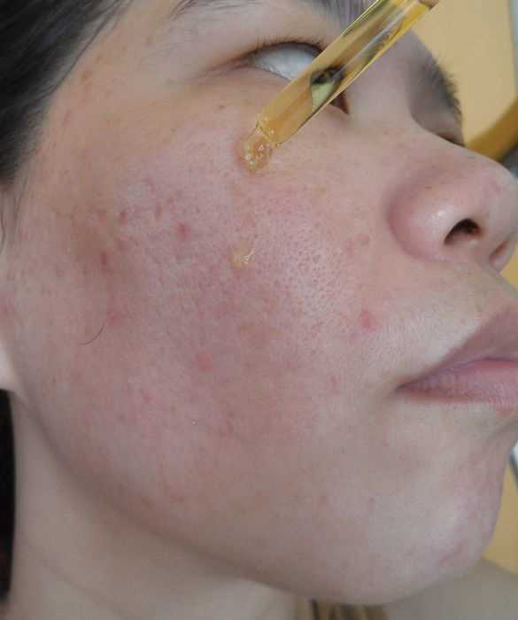 鑽美姬面皰粉刺油脂調理精華預防面皰粉刺