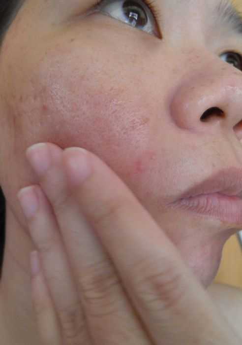 鑽美姬面皰粉刺油脂調理精華預防面皰粉刺