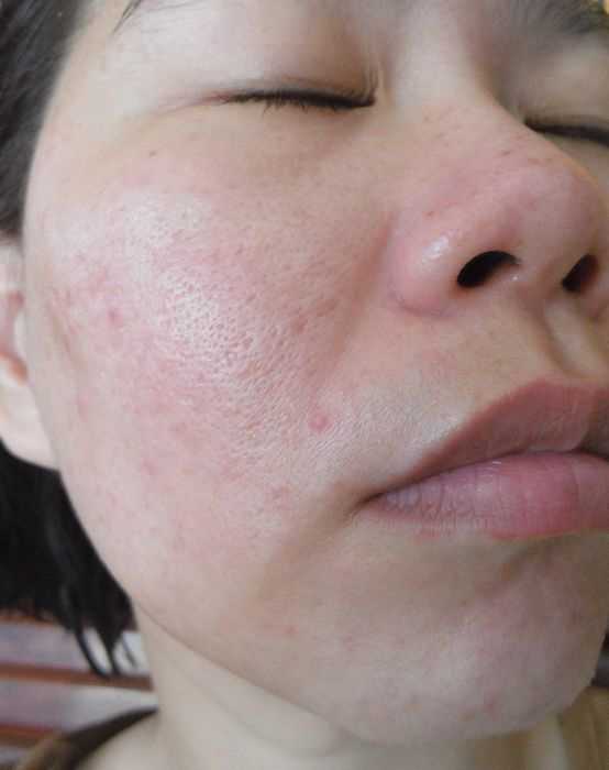 鑽美姬面皰粉刺油脂調理精華預防面皰粉刺