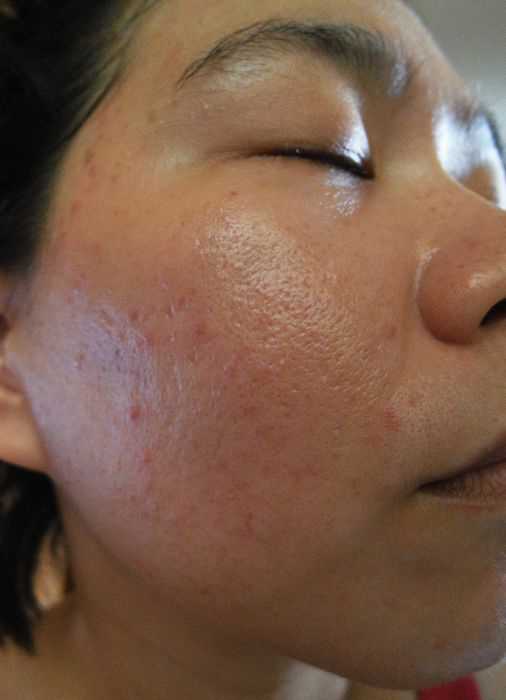 鑽美姬面皰粉刺油脂調理精華預防面皰粉刺