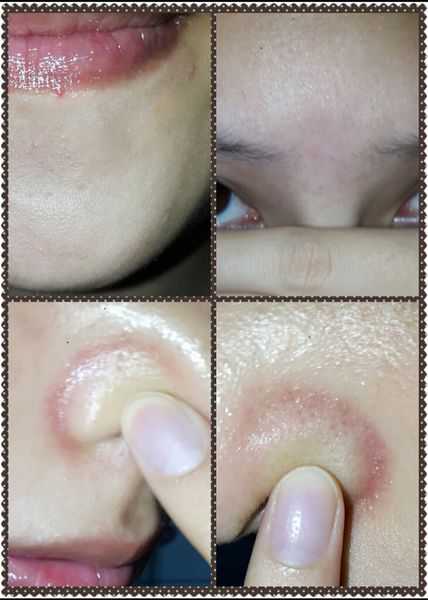 鑽美姬面皰粉刺油脂調理精華預防面皰粉刺