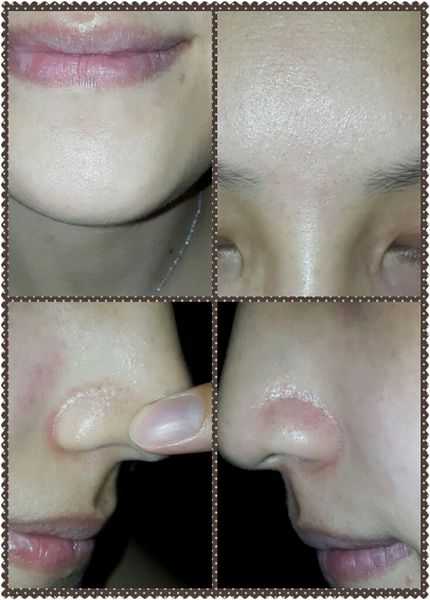 鑽美姬面皰粉刺油脂調理精華預防面皰粉刺