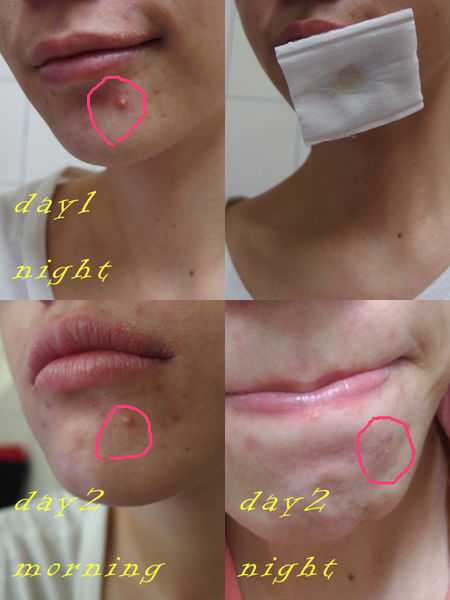 鑽美姬面皰粉刺油脂調理精華預防面皰粉刺