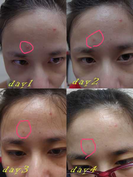 鑽美姬面皰粉刺油脂調理精華預防面皰粉刺