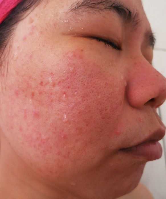 鑽美姬面皰粉刺油脂調理精華預防面皰粉刺