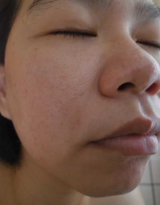 鑽美姬面皰粉刺油脂調理精華預防面皰粉刺