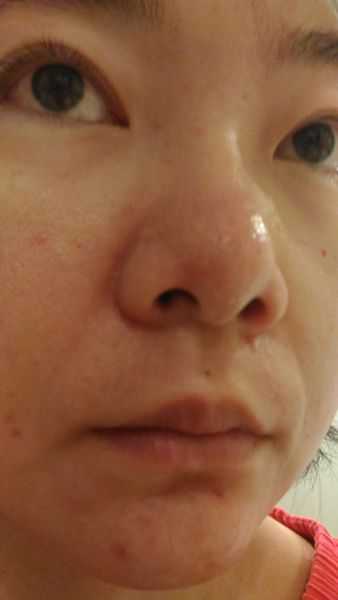 鑽美姬面皰粉刺油脂調理精華預防面皰粉刺