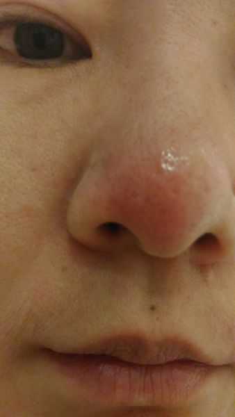 鑽美姬面皰粉刺油脂調理精華預防面皰粉刺