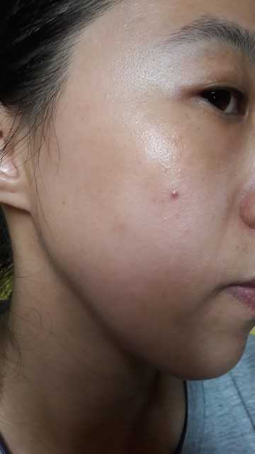 鑽美姬面皰粉刺油脂調理精華預防面皰粉刺