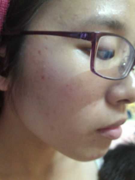 鑽美姬面皰粉刺油脂調理精華預防面皰粉刺