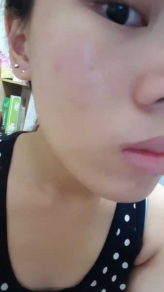 鑽美姬面皰粉刺油脂調理精華