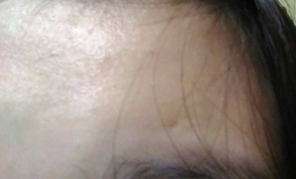 鑽美姬面皰粉刺油脂調理精華預防面皰粉刺