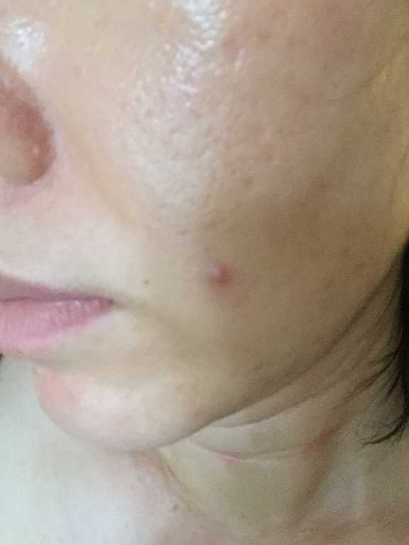 鑽美姬面皰粉刺油脂調理精華預防面皰粉刺