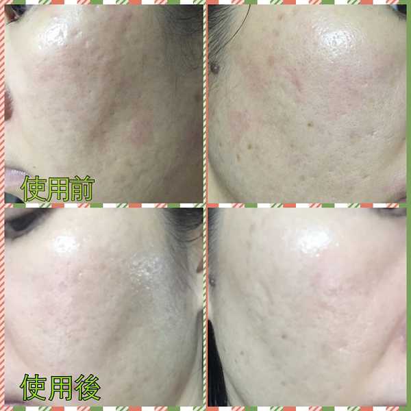 鑽美姬面皰粉刺油脂調理精華預防面皰粉刺