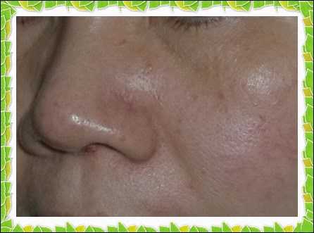 鑽美姬面皰粉刺油脂調理精華預防面皰粉刺