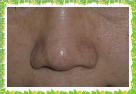 鑽美姬面皰粉刺油脂調理精華預防面皰粉刺