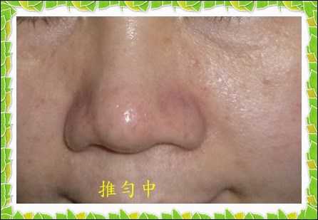 鑽美姬面皰粉刺油脂調理精華預防面皰粉刺