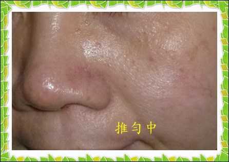 鑽美姬面皰粉刺油脂調理精華預防面皰粉刺