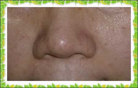 鑽美姬面皰粉刺油脂調理精華預防面皰粉刺