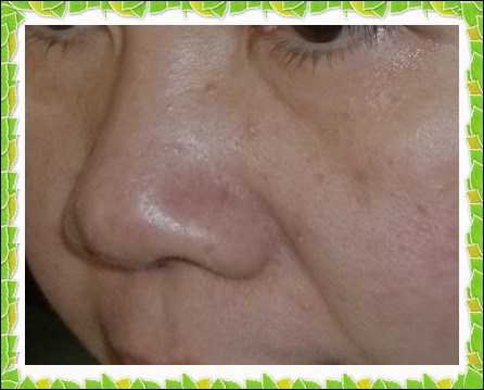 鑽美姬面皰粉刺油脂調理精華預防面皰粉刺