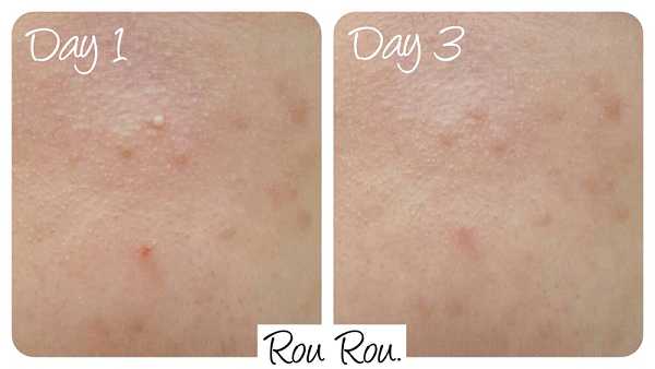 鑽美姬面皰粉刺油脂調理精華預防面皰粉刺