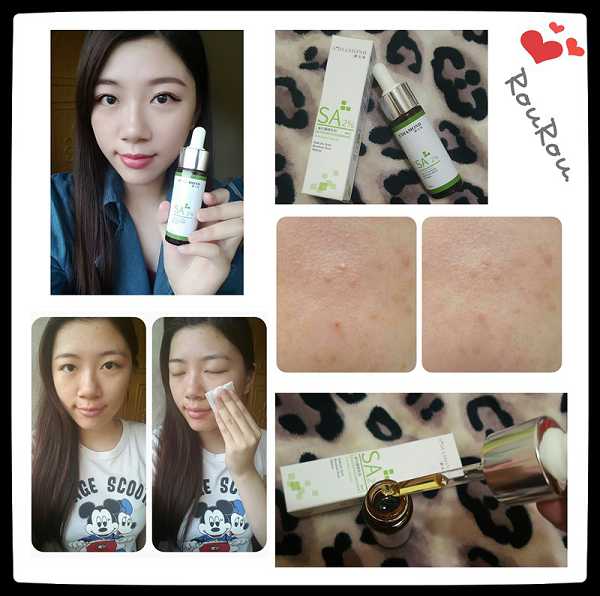 鑽美姬面皰粉刺油脂調理精華預防面皰粉刺