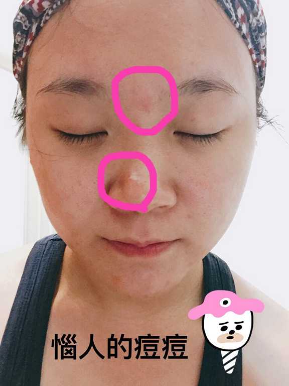 鑽美姬面皰粉刺油脂調理精華預防面皰粉刺