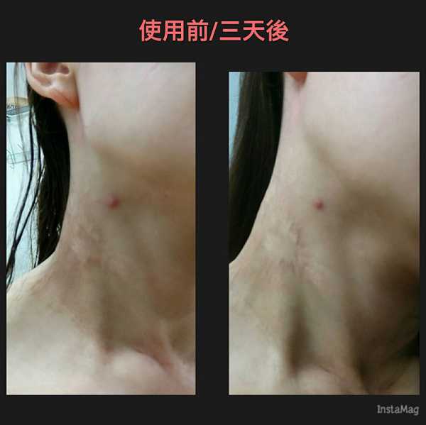 鑽美姬面皰粉刺油脂調理精華預防面皰粉刺