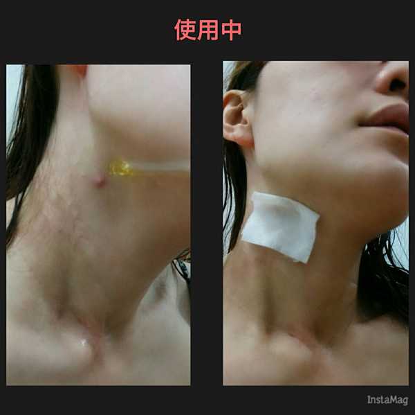 鑽美姬面皰粉刺油脂調理精華預防面皰粉刺