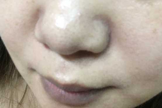 鑽美姬面皰粉刺油脂調理精華預防面皰粉刺