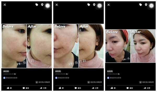 鑽美姬面皰粉刺油脂調理精華預防面皰粉刺