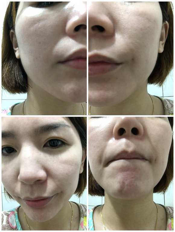 鑽美姬面皰粉刺油脂調理精華預防面皰粉刺