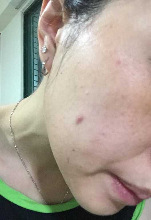 鑽美姬面皰粉刺油脂調理精華預防面皰粉刺