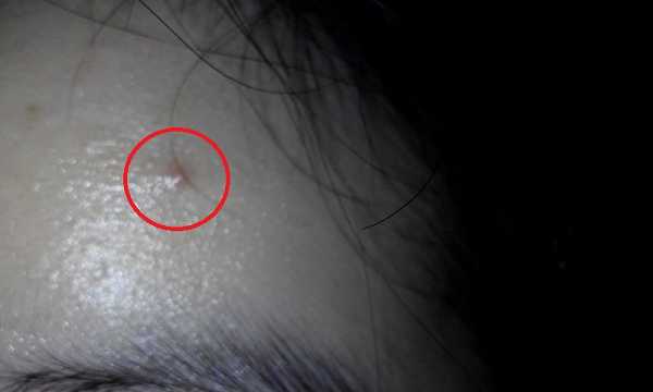 鑽美姬面皰粉刺油脂調理精華預防面皰粉刺