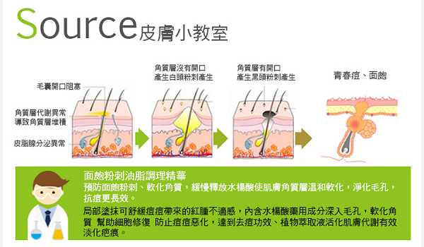 鑽美姬面皰粉刺油脂調理精華預防面皰粉刺
