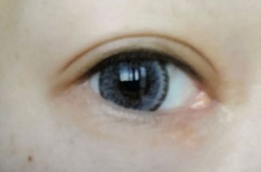 eyebefore