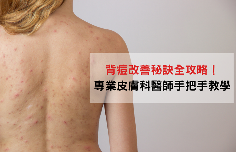 背痘改善秘訣全攻略!專業皮膚科醫師手把手教學 擺脫背部爛痘好簡單