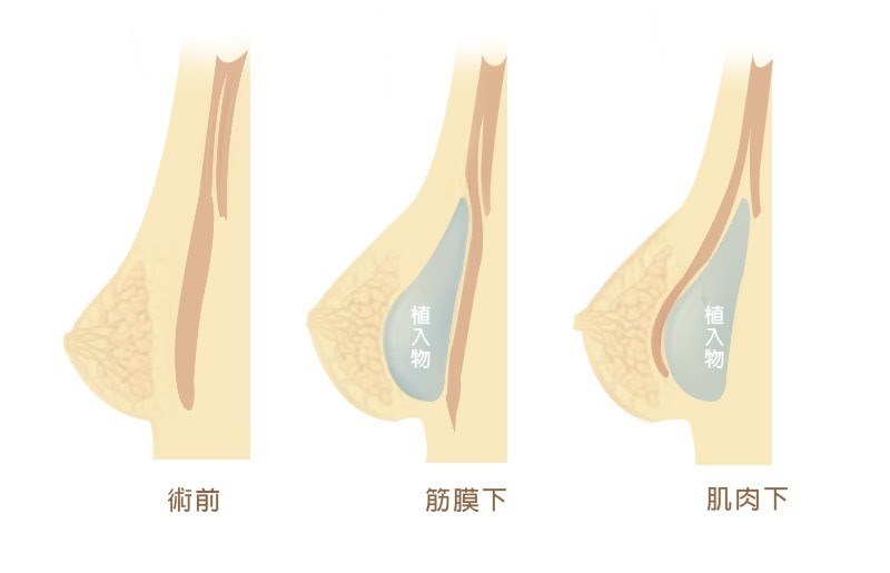 隆乳手術不失敗，高雄醫師推薦四大關鍵