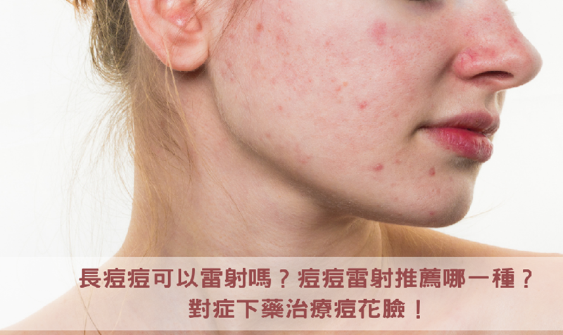 長痘痘可以雷射嗎?痘痘雷射推薦哪一種?對症下藥治療痘花臉!