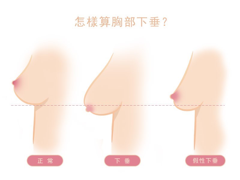 女人知己試用大隊 口碑行銷平台 專家文章分享 高雄隆乳 怎樣算胸部下垂 胸部下垂的定義和原因 怎麼用水滴型果凍隆乳改善下垂胸型 高雄蘇毓彬醫師